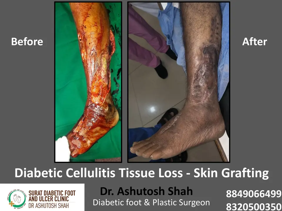 Diabetic Cellulitis and Coverage.pptx-6.webp